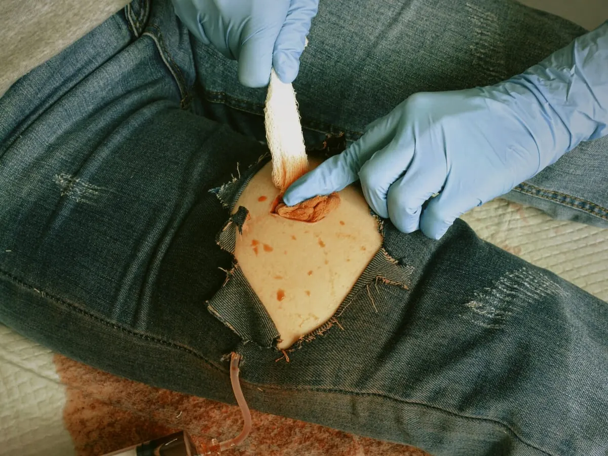 Wound packing em simulação de trauma de membro